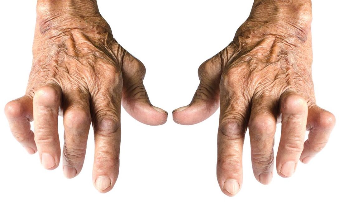 znaki artritisa - deformacija sklepov