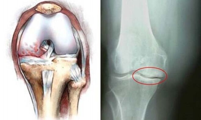 rentgenska artroza kolena