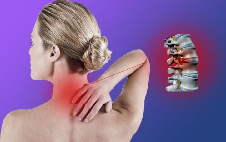 Osteohondroza vratne hrbtenice vodi do razvoja medvretenčne kile