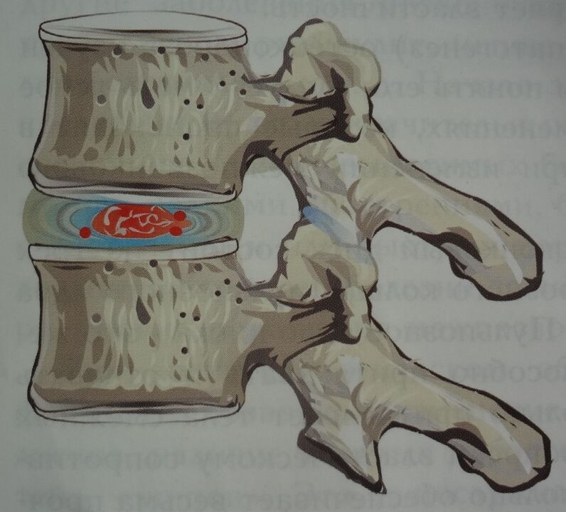 Poškodba pulposnega jedra medvretenčne ploščice na prvi stopnji cervikalne osteohondroze