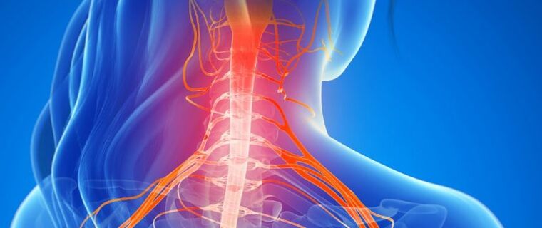 Stiskanje žil hrbtenjače pri osteohondrozi vratne hrbtenice