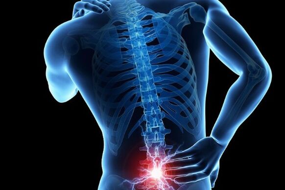 Akutna bolečina v spodnjem delu hrbta je simptom premika medvretenčnih ploščic