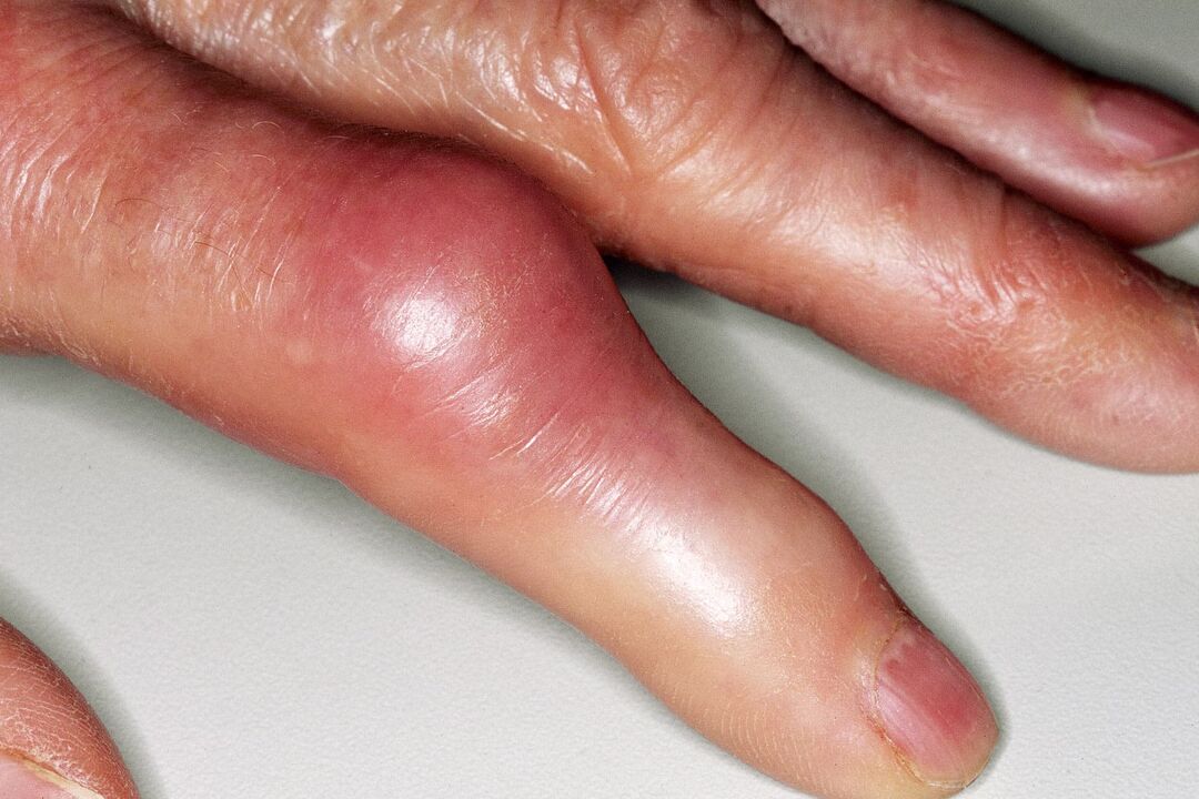 Oteklina, deformacija sklepa prsta in akutna bolečina po poškodbi