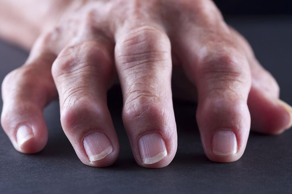 Za bursitis so značilne bolečine, vnetje in otekanje sklepov prstov