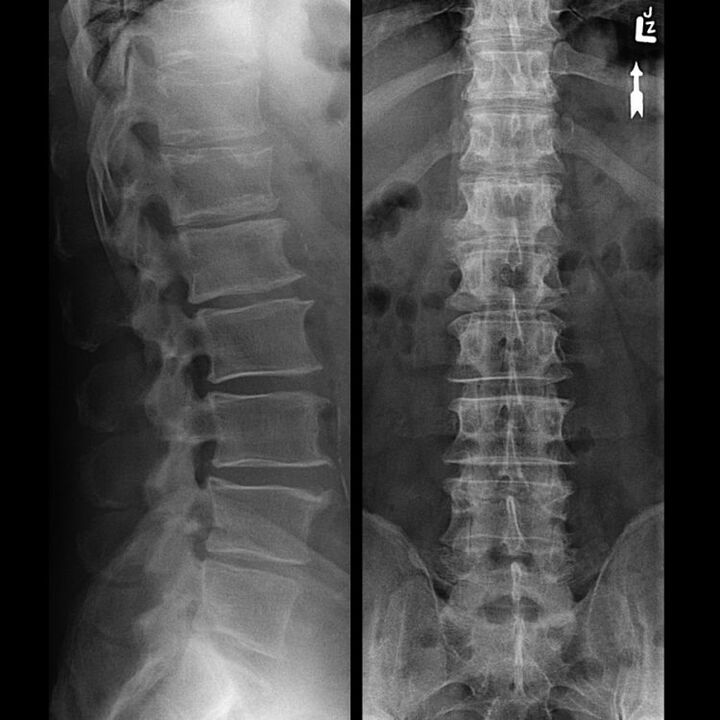 Sncing hrbtenice z osteohondrozo