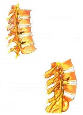 Prikaz osteohondroze hrbtenice